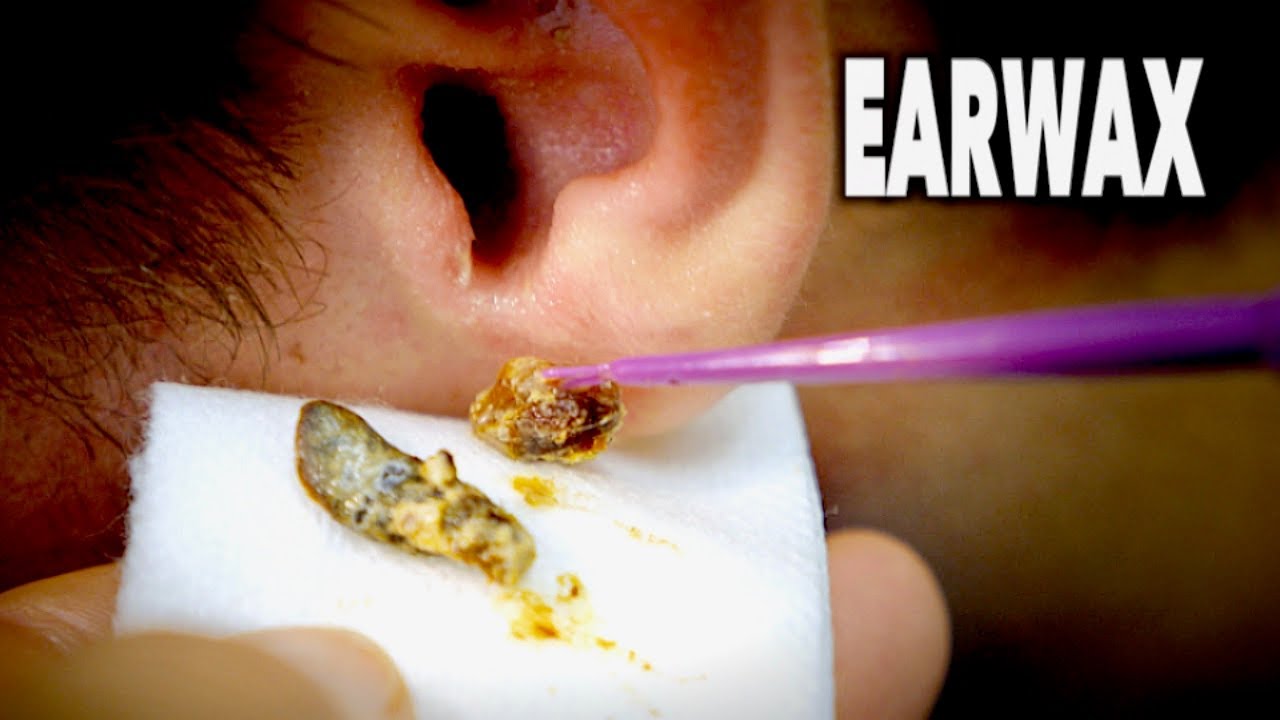 Removing Earwax